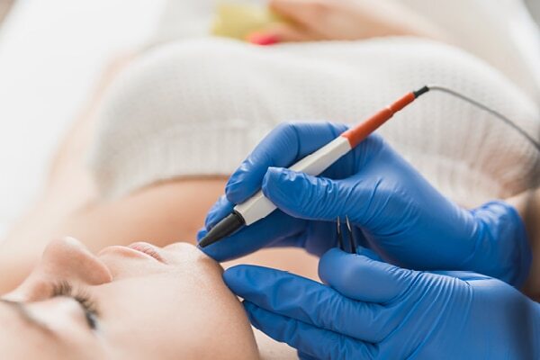FAQs about electrolysis hair removal
