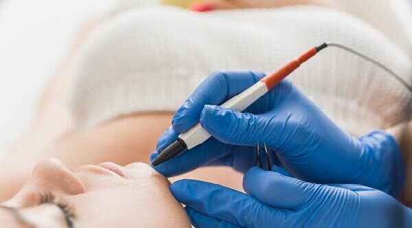 FAQs about electrolysis hair removal