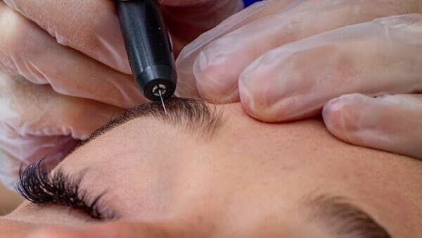 FAQs about electrolysis hair removal