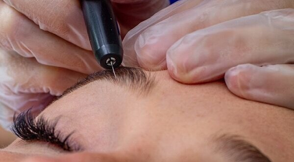 FAQs about electrolysis hair removal