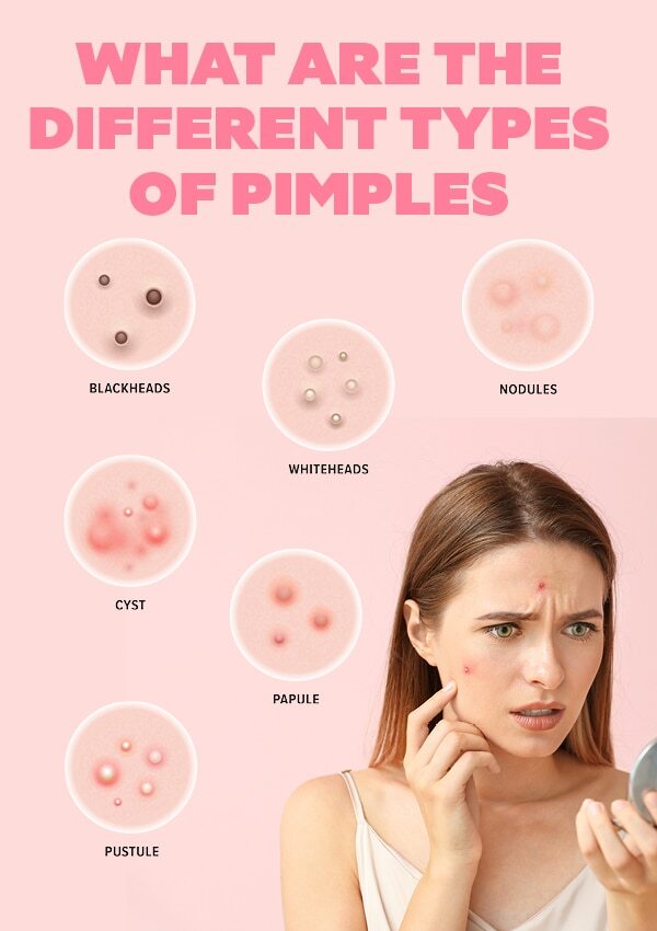 Cinnamon and honey for pimple free skin