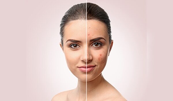 7 Natural Remedies For Acne Treatment At Home