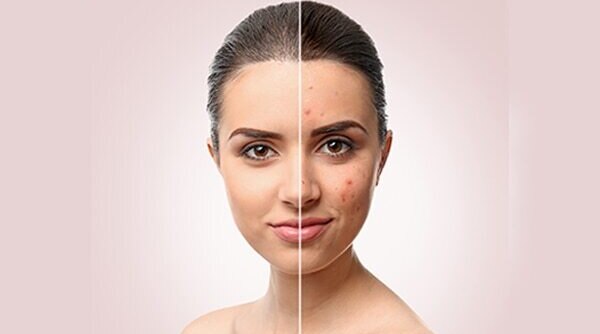 7 Natural Remedies For Acne Treatment At Home