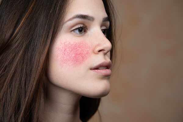 Home remedies for acne
