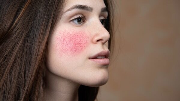 Home remedies for acne