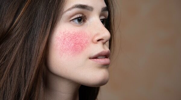 Home remedies for acne