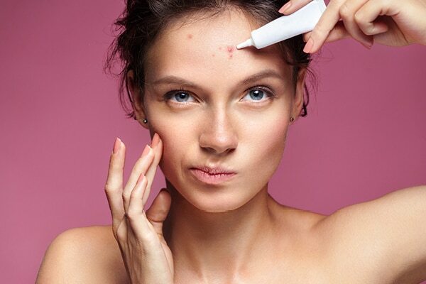 Home remedies for acne