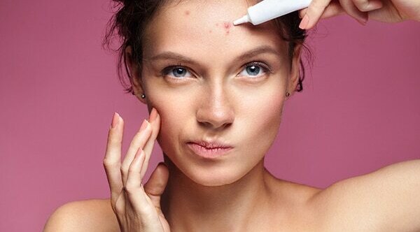 Home remedies for acne