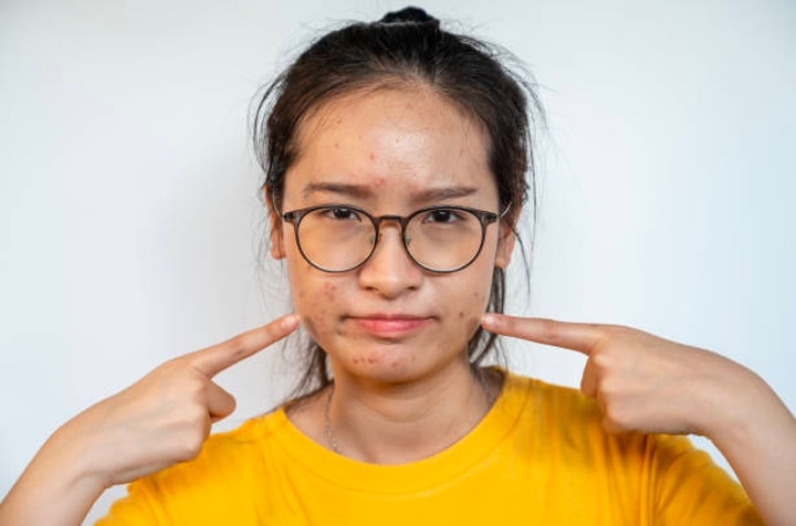 Beyond Cleansing: A Comprehensive Skincare Guide For Oily Skin