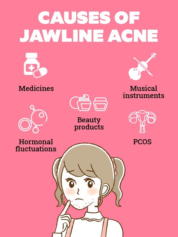 FAQs about jawline acne