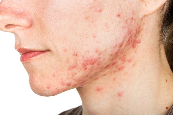 FAQs about jawline acne
