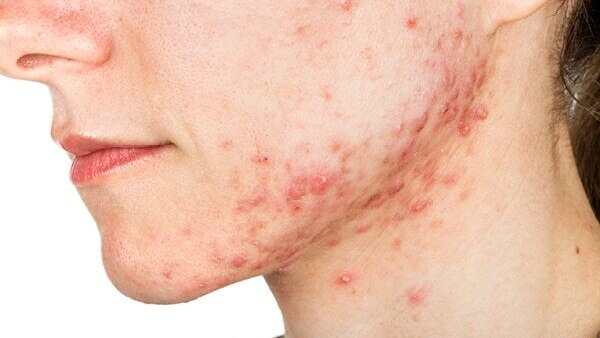 FAQs about jawline acne