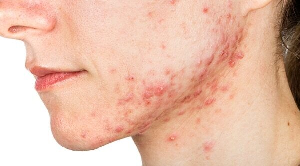 FAQs about jawline acne