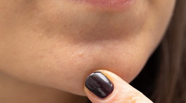 FAQs about jawline acne
