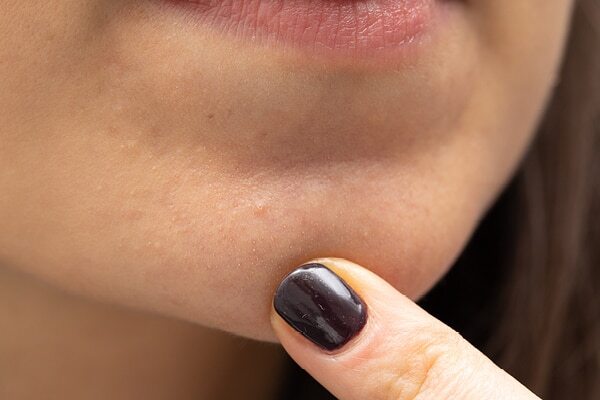 FAQs about jawline acne