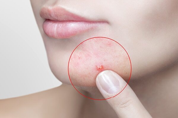 FAQs about jawline acne