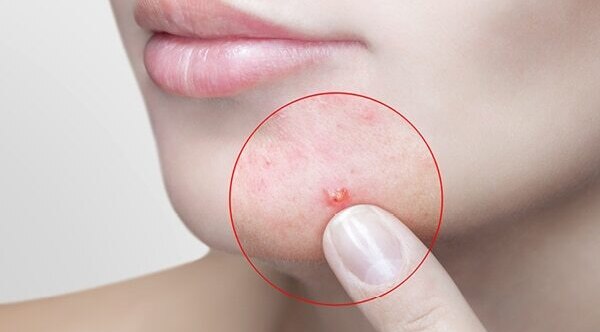 FAQs about jawline acne