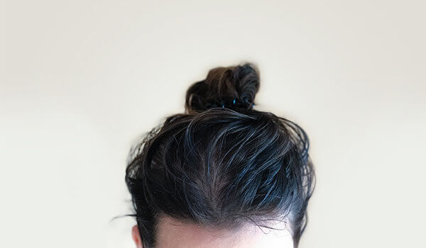 How To Treat Fungal Infections In Your Scalp