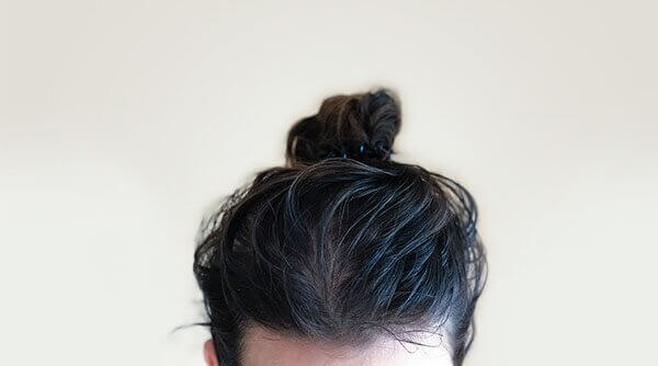 How To Treat Fungal Infections In Your Scalp