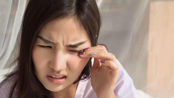 FAQ on Home Remedies for Styes on Eyes