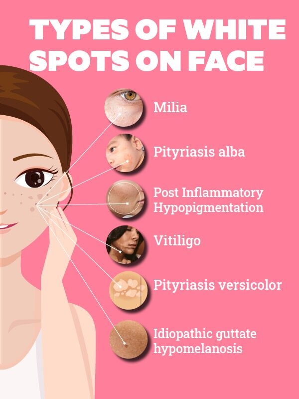 FAQs about white spots on face