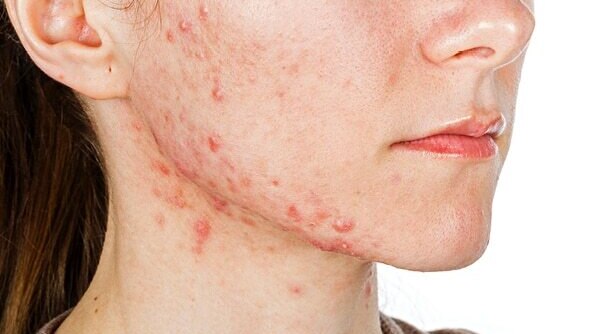 Zit-Zap-Zoom! Here’s How You Can Treat Hormonal Acne On The Jaw And Chin