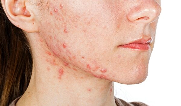 Zit-Zap-Zoom! Here’s How You Can Treat Hormonal Acne On The Jaw And Chin