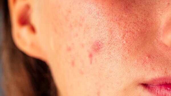 How to treat hormonal acne