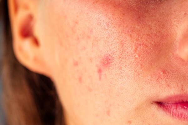 How to treat hormonal acne