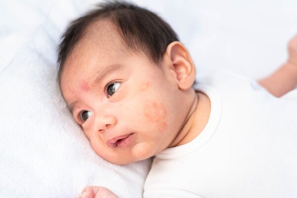 FAQs about white spots on face