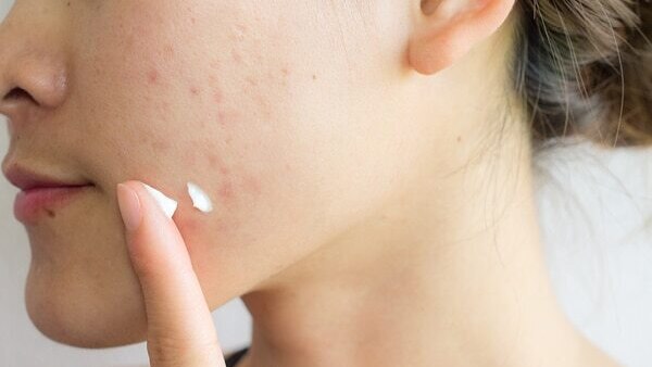 How to treat hormonal acne