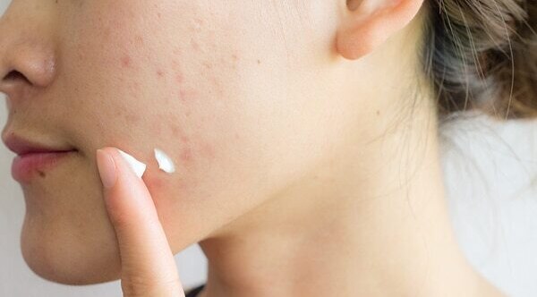How to treat hormonal acne