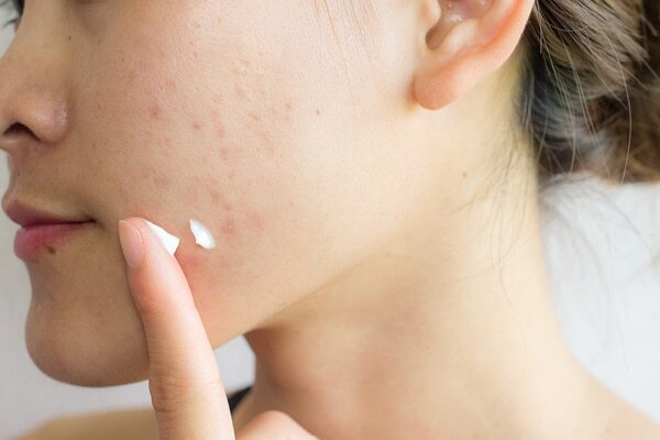How to treat hormonal acne