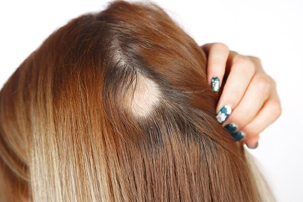 FAQs about alopecia treatment