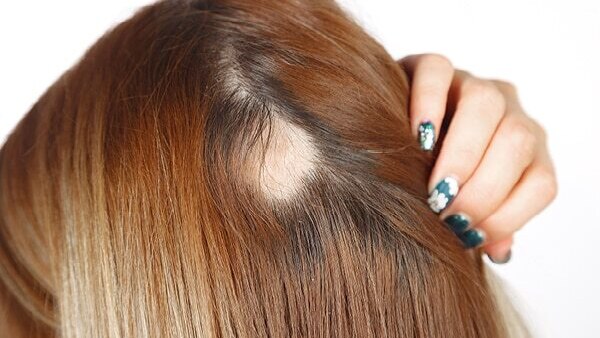 FAQs about alopecia treatment