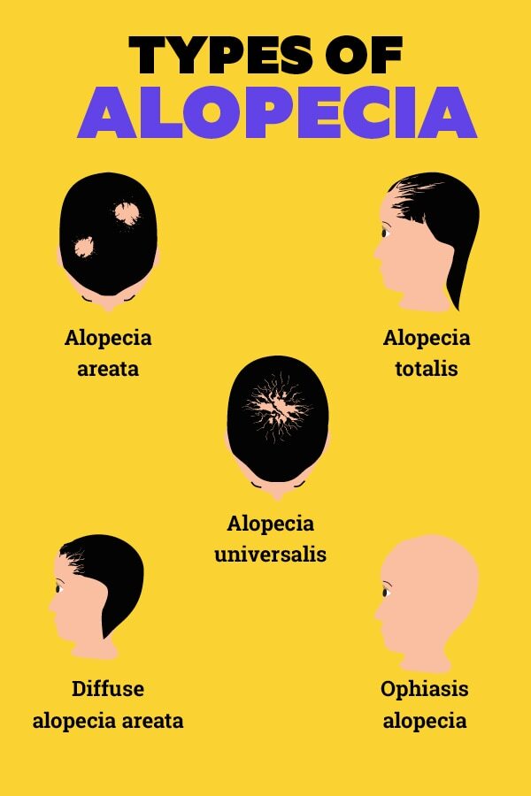 FAQs about alopecia treatment