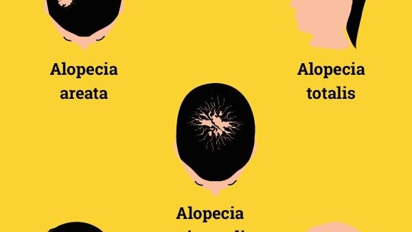 FAQs about alopecia treatment