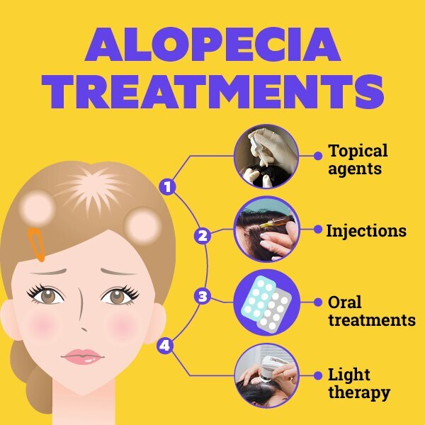 FAQs about alopecia treatment
