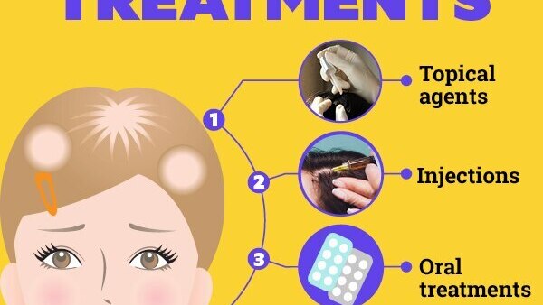 FAQs about alopecia treatment