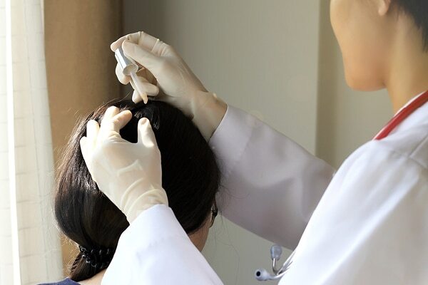 FAQs about alopecia treatment