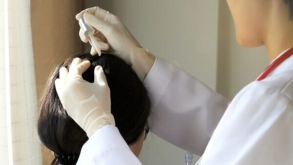 FAQs about alopecia treatment