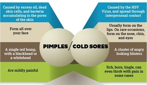 FAQs about cold sore vs. pimples