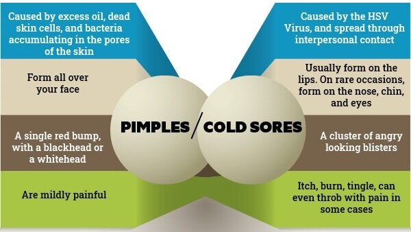 FAQs about cold sore vs. pimples