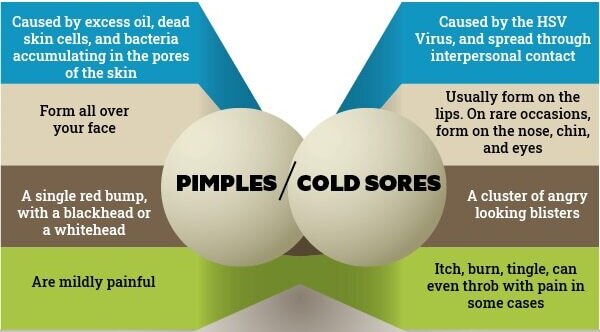 FAQs about cold sore vs. pimples