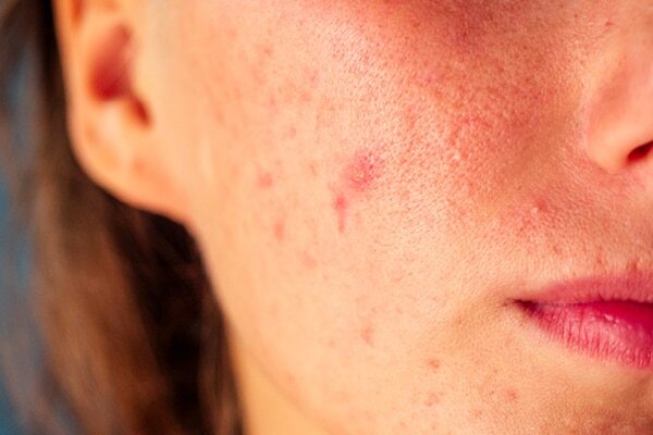 FAQs about cold sore vs. pimples