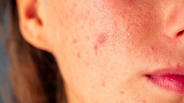 FAQs about cold sore vs. pimples