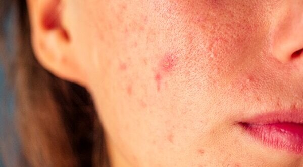 FAQs about cold sore vs. pimples