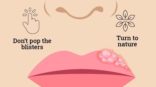 FAQs about cold sore vs. pimples