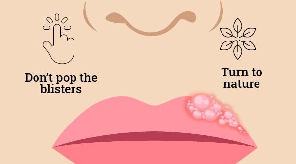FAQs about cold sore vs. pimples