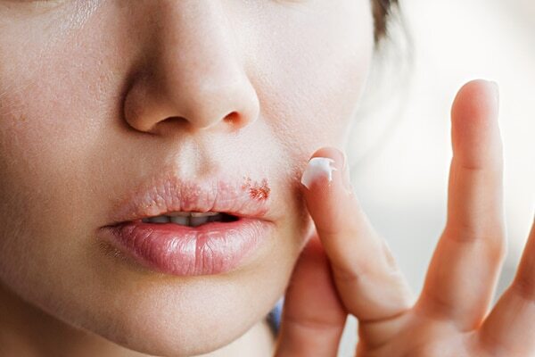 FAQs about cold sore vs. pimples
